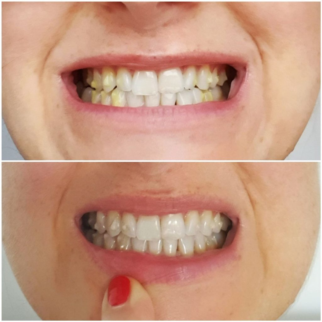 piękne zęby przed i po